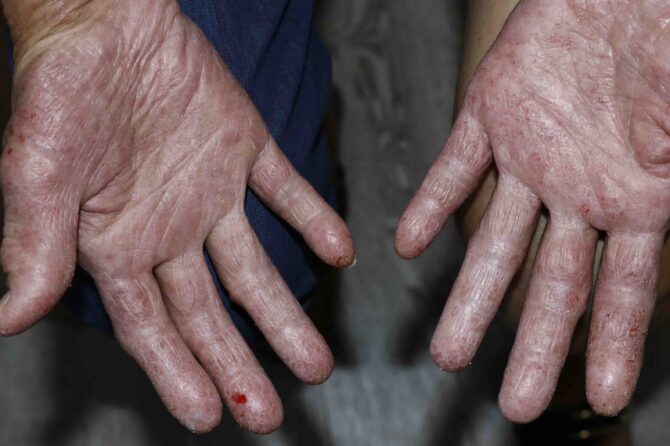 Steroid-Induced Skin Changes: Exploring Discoloration in Lesions