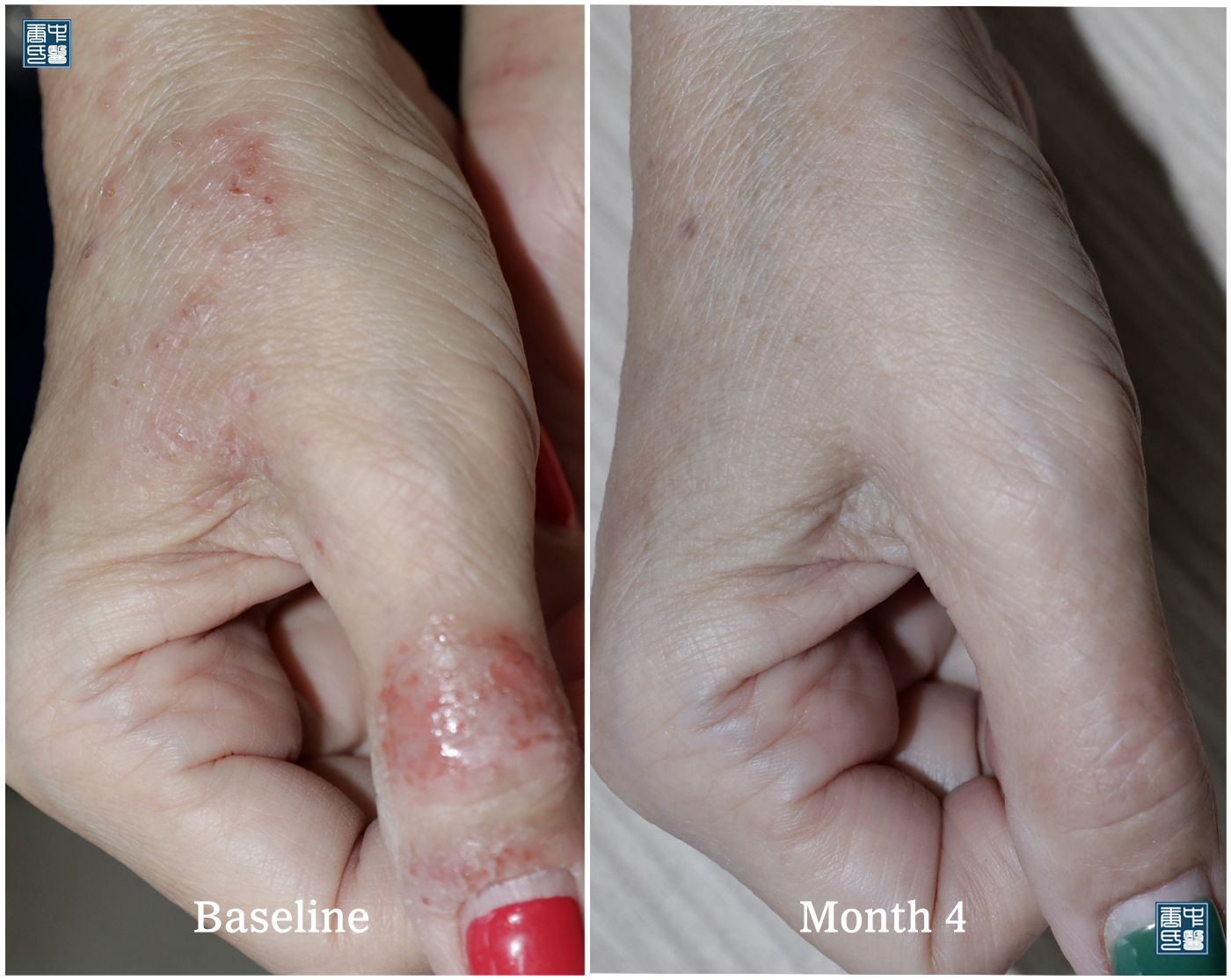 fingerTip eczema 3