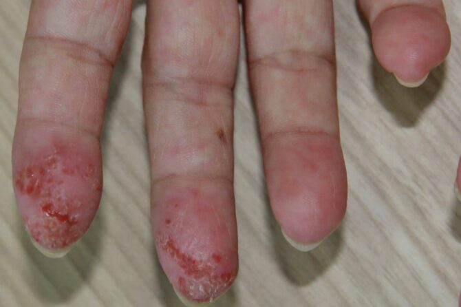 Fingerprints have been successfully reinstated 指纹恢复了