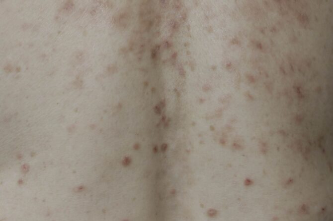 Nilotinib-Induced Extensive Skin Rashes and Alopecia in a Patient with Chronic Myeloid Leukemia: A Case Report and Herbal Medicine Approach