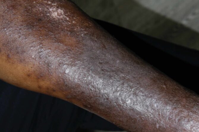 Herbal Approach to Chronic Eczema: A Case Study on the Efficacy of Traditional Chinese Medicine