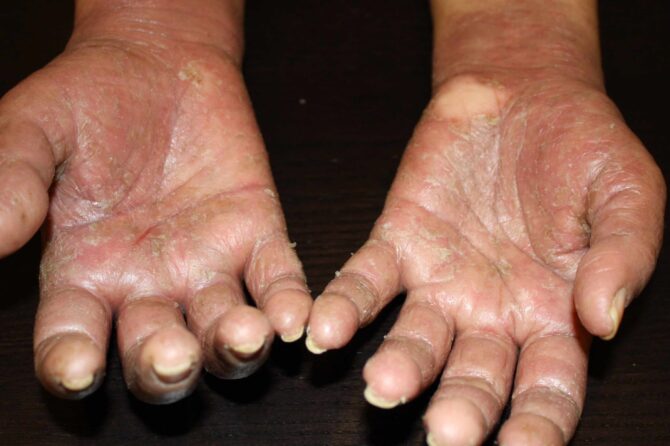 Hand Eczema: A Journey from Steroid Withdrawal to Herbal Medicine 手部湿疹:从类固醇戒断到重草药治疗的旅程