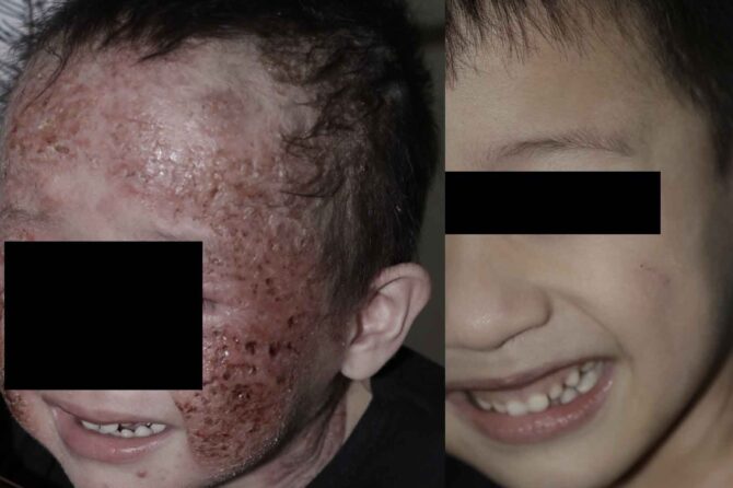 From Flare-Up to Freedom: A Toddler’s Triumph Over Severe Eczema 幼儿严重湿疹