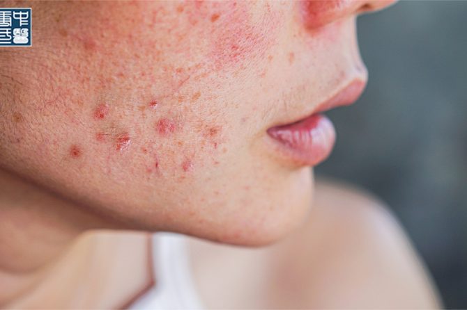 Debunking Acne Myths in TCM and Modern Science Perspectives