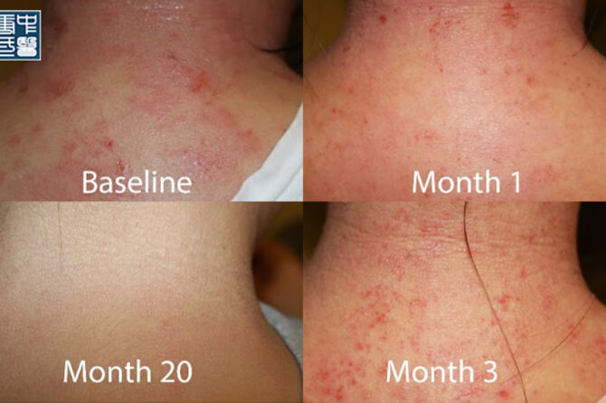 Foods that trigger eczema