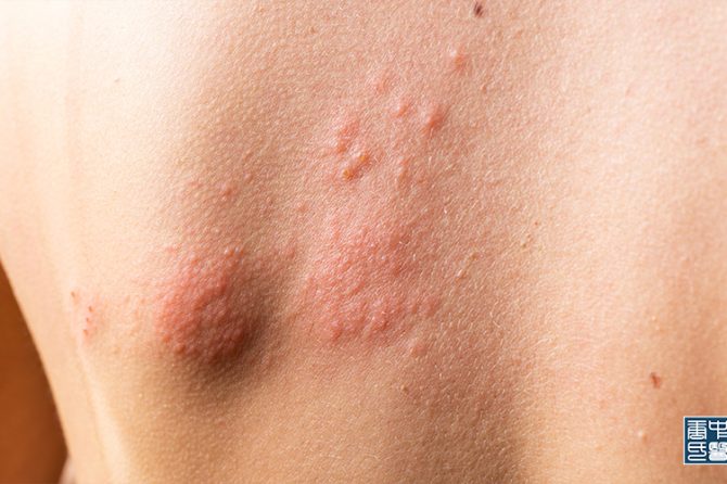 The TCM Approach: How Balancing the Five Elements Can Help Treat Hives