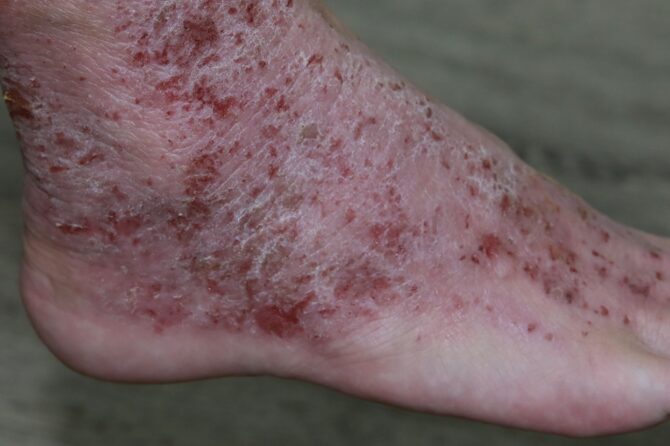What Factors Affect Eczema Severity Differently in Singapore, the United States, and Batam Island? 到底是哪些因素导致湿疹严重程度在新加坡、美国和巴淡岛存在差异？