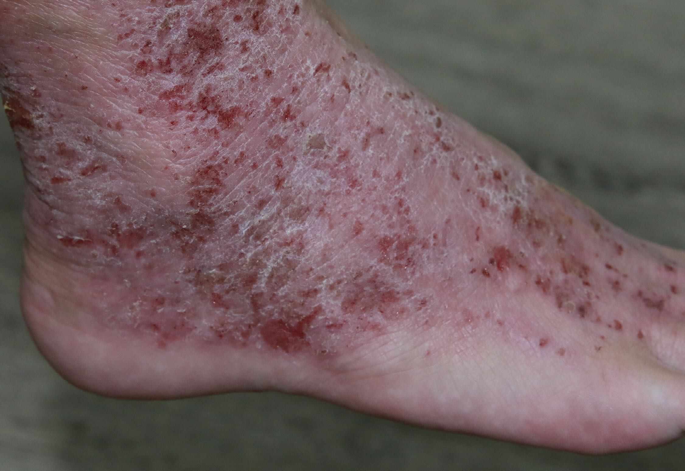 What Factors Affect Eczema Severity Differently in Singapore, the United States, and Batam Island? 到底是哪些因素导致湿疹严重程度在新加坡、美国和巴淡岛存在差异？