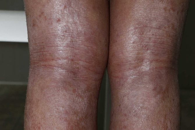 A Journey Through Steroid Withdrawal and Alternative Healing: Overcoming Severe Eczema in 24 Months 戒断激素与中药疗法的愈合之路：24个月战胜重度湿疹湿疹