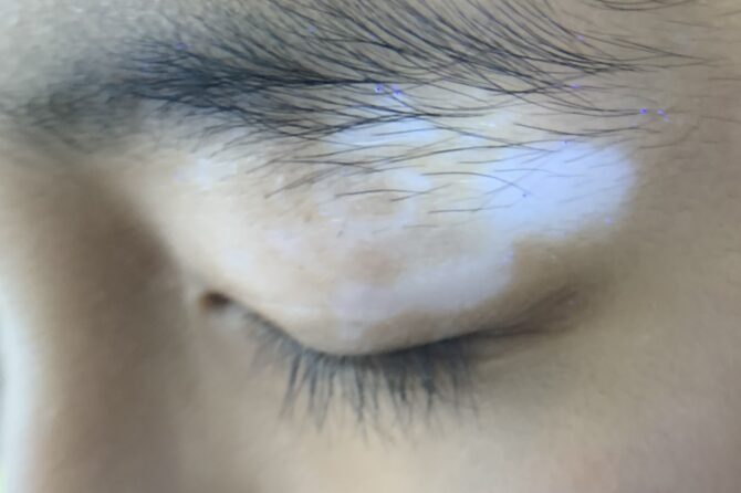 Long-Term Efficacy of Traditional Chinese Medicine in Treating Pediatric Eyelid Vitiligo: A Four-Year Case Study 中药治疗儿童白癜风的长期疗效：四年病例研究