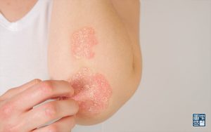 Woman's elbow with psoriasis