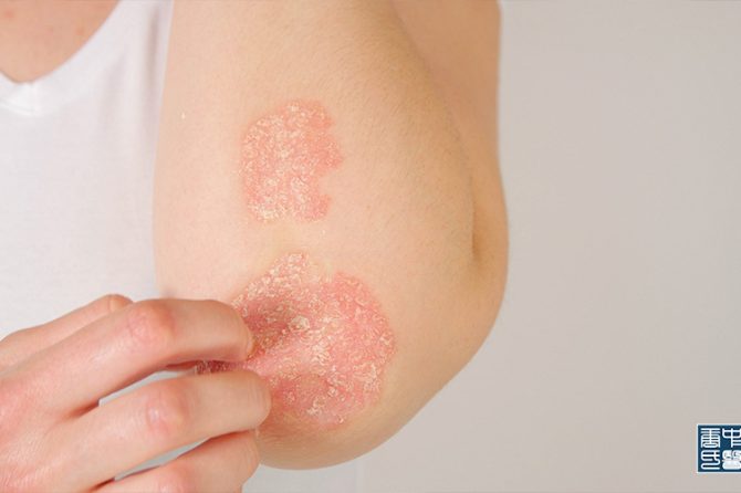 Types of Psoriasis and How TCM Can Address it