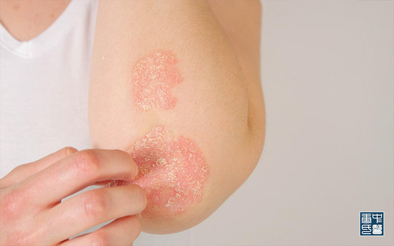 Types of Psoriasis and How TCM Can Address it