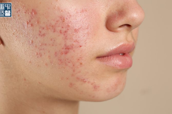 Understanding and Treating Different Types of Acne through TCM