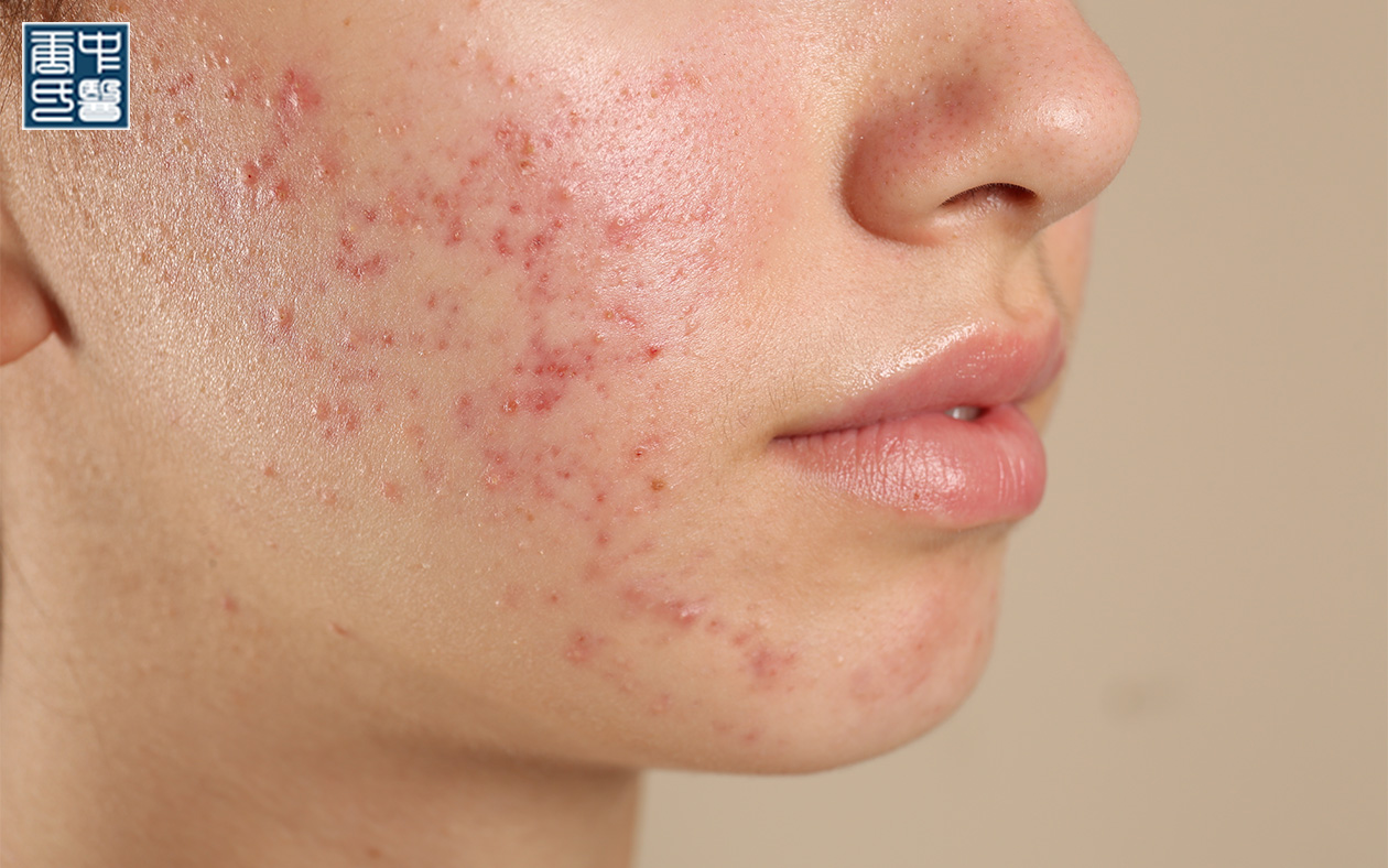 Woman's face with acne