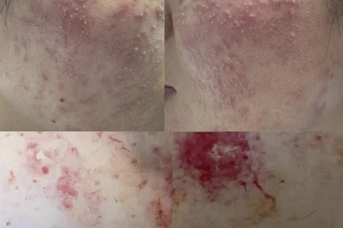 Management of Steroid-Induced Acneiform Eruptions and Facial Telangiectasia: A 14-Month Case Study of TCM Herbal Treatment 类固醇诱发痤疮样皮疹及面部毛细血管扩张的中药管理