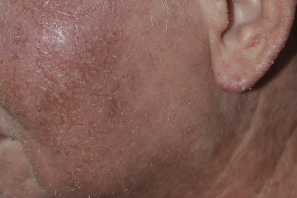 Managing Acute Allergic Reactions and Corticosteroid Withdrawal: A Case Study of Contact Dermatitis and Eczema Treatment 急性过敏反应与皮质激素戒断管理：接触性皮炎与湿疹治疗案例分析