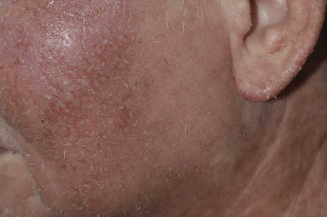 Managing Acute Allergic Reactions and Corticosteroid Withdrawal: A Case Study of Contact Dermatitis and Eczema Treatment 急性过敏反应与皮质激素戒断管理：接触性皮炎与湿疹治疗案例分析