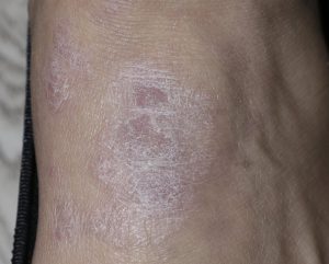 eczema on foot