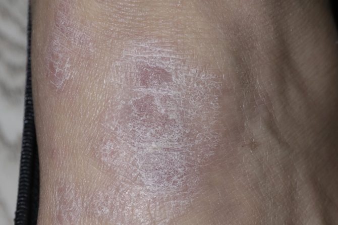 A 43-Year-Old’s Journey to Clear Skin with TCM for Chronic Eczema 43岁女性通过中医治疗慢性湿疹恢复健康之旅