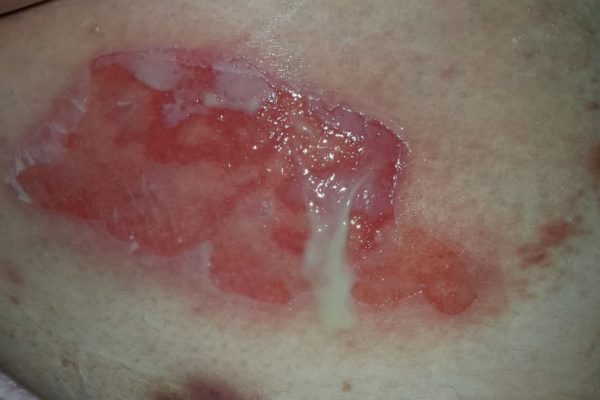 Continuing Care: Assisting a Family with Pemphigus Treatment 持续关怀：帮助一家人进行天疱疮治疗