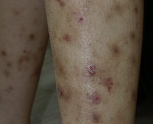 eczema on legs