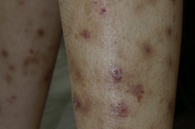 Overcoming Steroid Dependency: A Case Study on Eczema Recovery Through Traditional Chinese Medicine 摆脱类固醇依赖：中医治疗湿疹康复案例研究