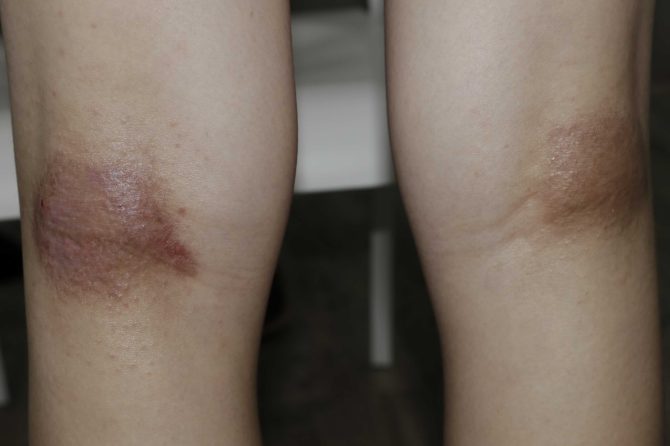 Long-Term Pediatric Eczema Management through Traditional Chinese Medicine: A 10-Month Observational Case Study 通过中药进行儿童湿疹的长期管理：为期10个月的观察性病例研究