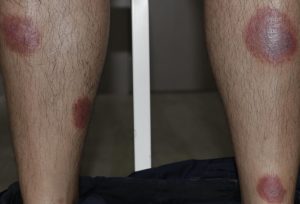psoriasis on leg