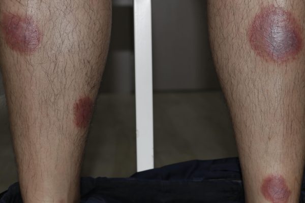 A Journey to Psoriasis Recovery with Traditional Chinese Medicine 中医治疗银屑病的康复之旅