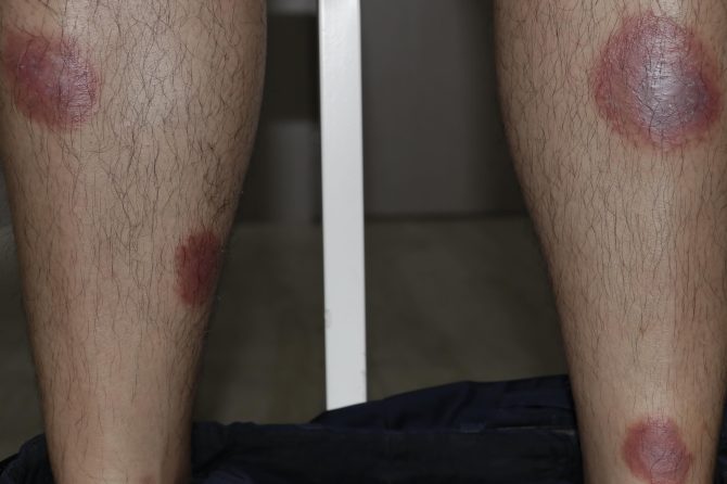 A Journey to Psoriasis Recovery with Traditional Chinese Medicine 中医治疗银屑病的康复之旅