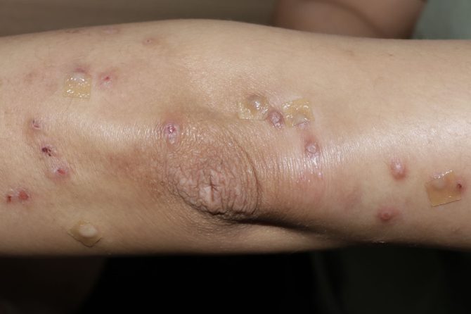 Successful Resolution of Prurigo Nodularis with Tailored TCM: A 15-Month Case Study 采用个性化中医治疗成功改善结节性痒疹：一项为期15个月的病例研究