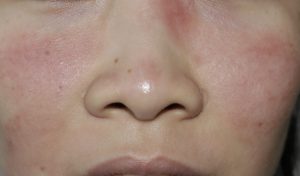 skin issue on face