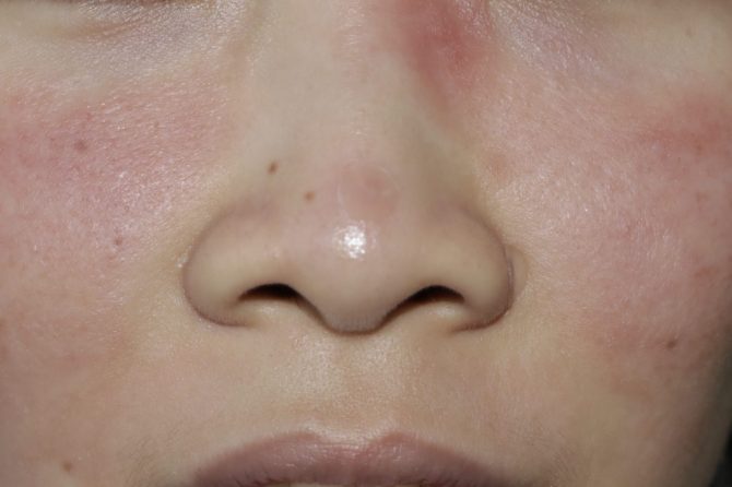Chronic Facial Redness and Rash with No Clear Trigger 无明显诱因的慢性面部红斑和皮疹