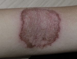 skin issue on arm