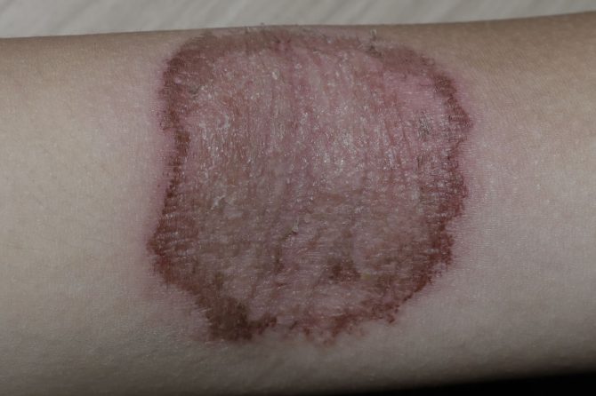 3 Months of Topical Steroid Use Necessitated 10 Months of TCM for Eczema Recovery