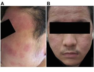 facial redness