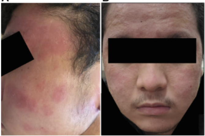Dupilumab Facial Redness (DFR): A Newly Identified Side Effect of Dupilumab Treatment 度普利尤单抗面部红斑(DFR): Dupilumab 治疗的新发现副作用