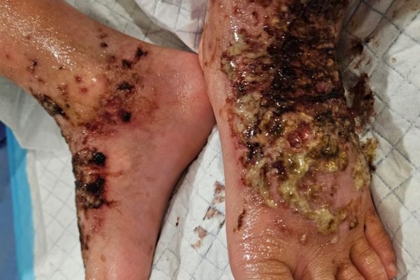Managing Atopic Eczema In Children 儿童湿疹