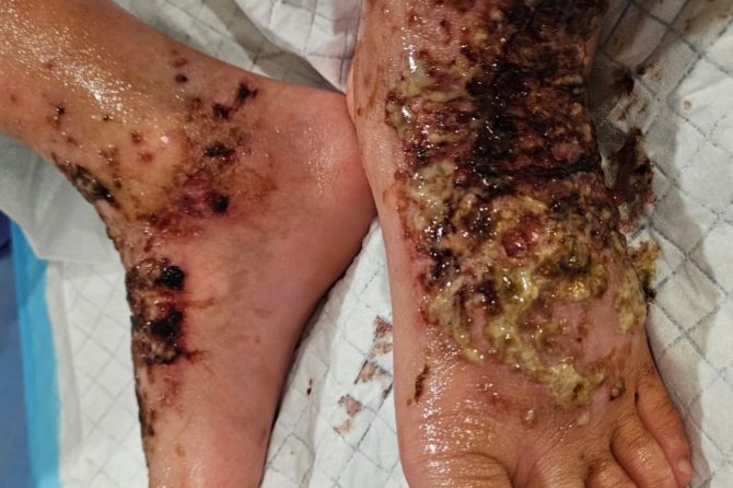 Managing Atopic Eczema In Children 儿童湿疹