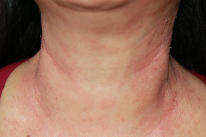 TCM-Induced Remission of Steroid-Rebound Hand Eczema: 14-Month Case Report 中药缓解激素反弹手湿疹：14个月病例报告