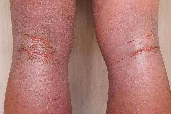 Eczema in a Crash-Loop Smartphone: Why Single-App Fixes Fail 把湿疹当作循环死机的手机：为什么“修一个 App”行不通