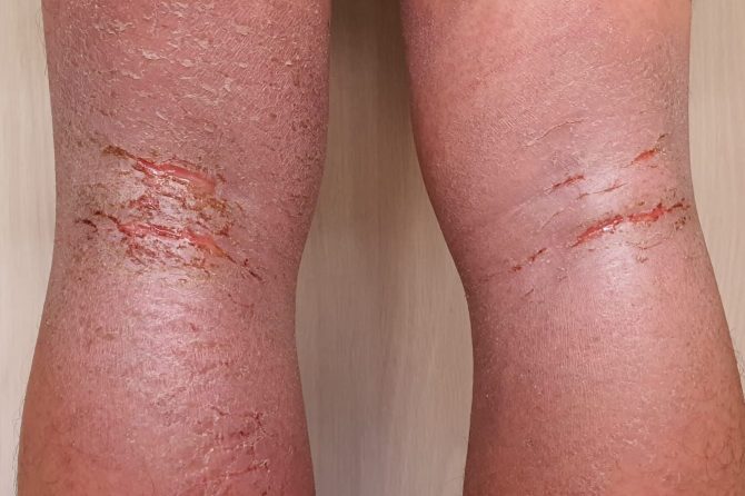 Eczema in a Crash-Loop Smartphone: Why Single-App Fixes Fail 把湿疹当作循环死机的手机：为什么“修一个 App”行不通