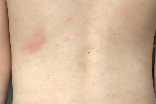 Healing Between Certainty and Ambiguity — A Child’s Journey Through Immune-Mediated Skin Disease 在确诊与未知之间的疗愈: 一位儿童免疫性皮肤病的康复之路