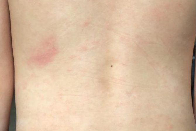 Healing Between Certainty and Ambiguity — A Child’s Journey Through Immune-Mediated Skin Disease 在确诊与未知之间的疗愈: 一位儿童免疫性皮肤病的康复之路