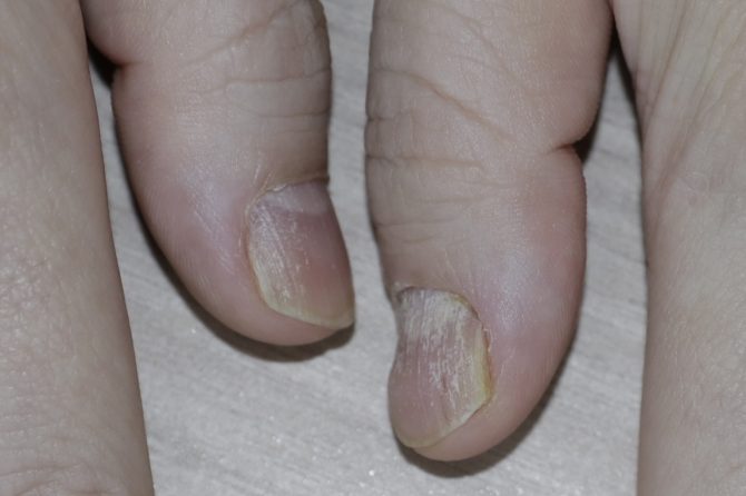 Isolated Nail Psoriasis: A Case Report with Ten-Month Photographic Follow-Up 孤立性甲银屑病：一例随附十个月影像随访的病例报告