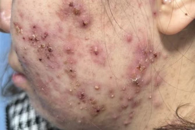 Internal Imbalances vs. External Invaders: A TCM View of Acne and Folliculitis 痘痘与毛囊炎的中医视角：内因失衡与外邪侵袭