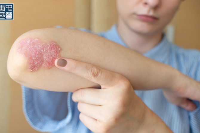 Is Psoriasis Contagious?