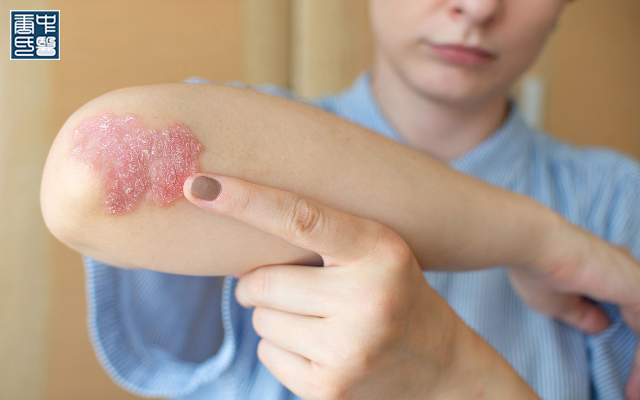 Person pointing at a psoriasis rash on their arm.