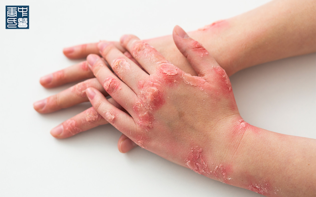 eczema
